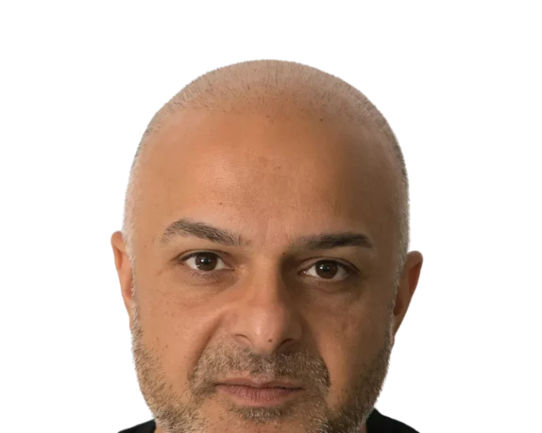 Vorher-Bild eines Kunden vor der Haarpigmentierung bei Scalp Frankfurt – Glatze mit Haarausfall.