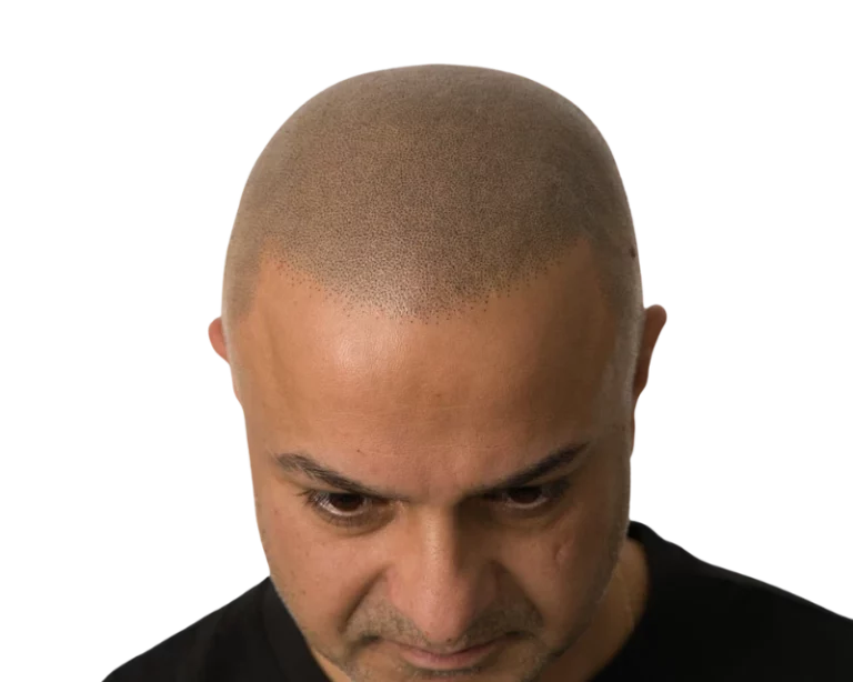 Perfekte Haarpigmentierung mit der Black Rain Technik bei Scalp Frankfurt – natürliches SMP-Ergebnis.