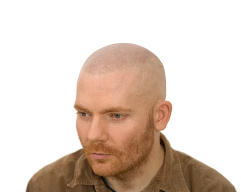 Exklusive Haarpigmentierung für rote Haare – Scalp Micropigmentation bei Scalp Frankfurt, einzigartig in Deutschland.