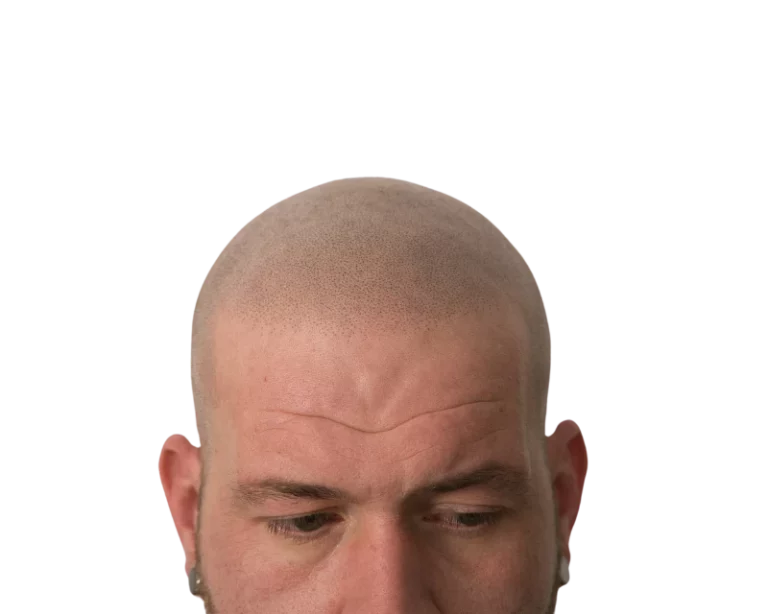 Fertige Haarpigmentierung bei Scalp Frankfurt – natürliche Scalp Micropigmentation für volleres Haar.