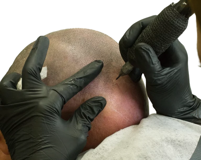Live-Haarpigmentierung bei Scalp Frankfurt – präzise Scalp Micropigmentation mit der Black Rain Technik.