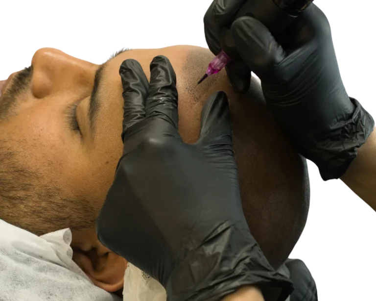 Live-Scalp Micropigmentation bei Scalp Frankfurt – präzise Haarpigmentierung mit der Black Rain Technik.