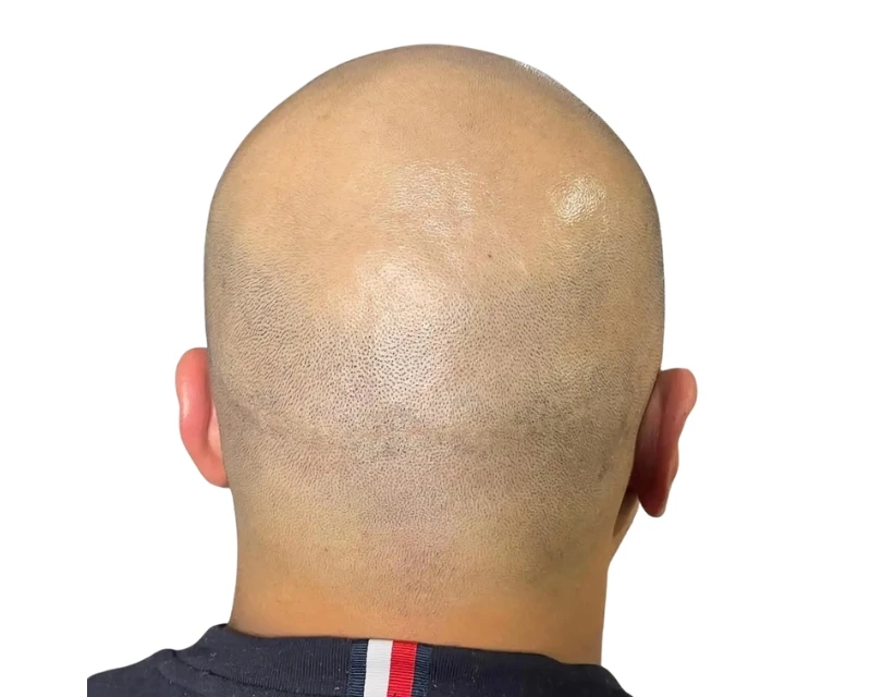 FUT-Narbe am Hinterkopf nach der Haarpigmentierung