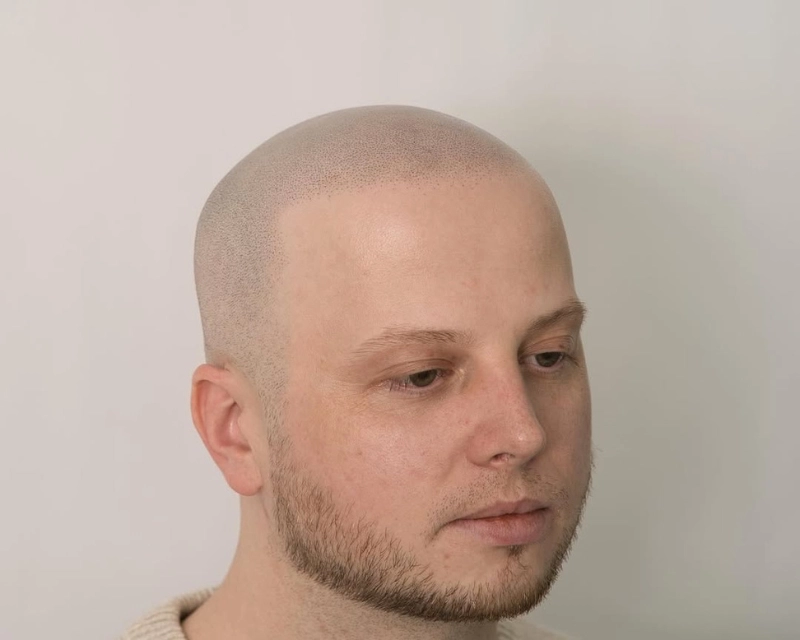 Nachher-Bild der Haarpigmentierung (blonder Kunde, helle Haut) – SMP-Ergebnis bei Scalp Frankfurt.