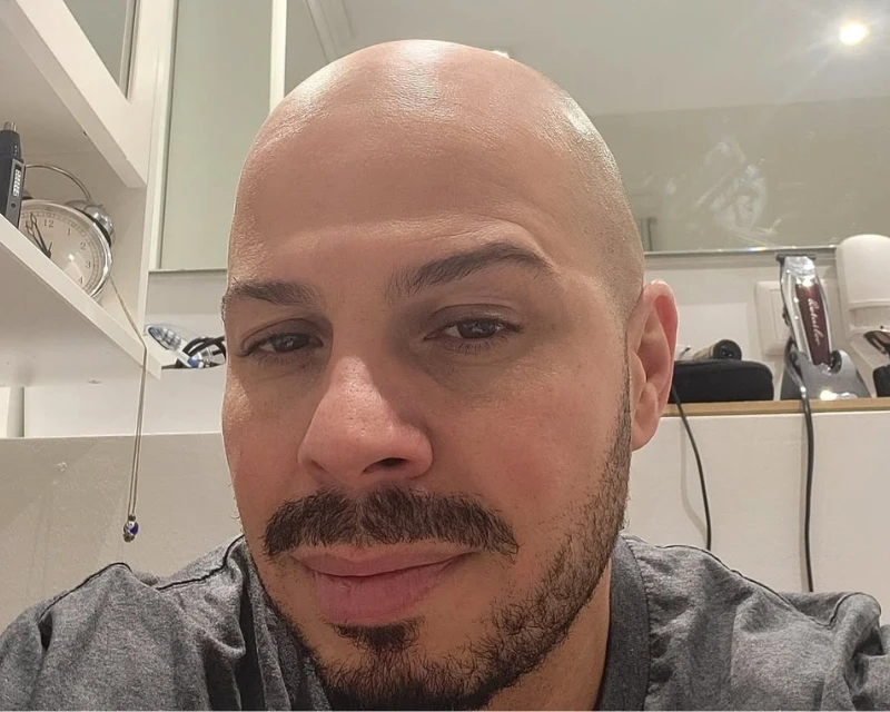 Vorher-Bild: Ausgeprägte Glatze am Hinterkopf vor der Haarpigmentierung bei Scalp Frankfurt.