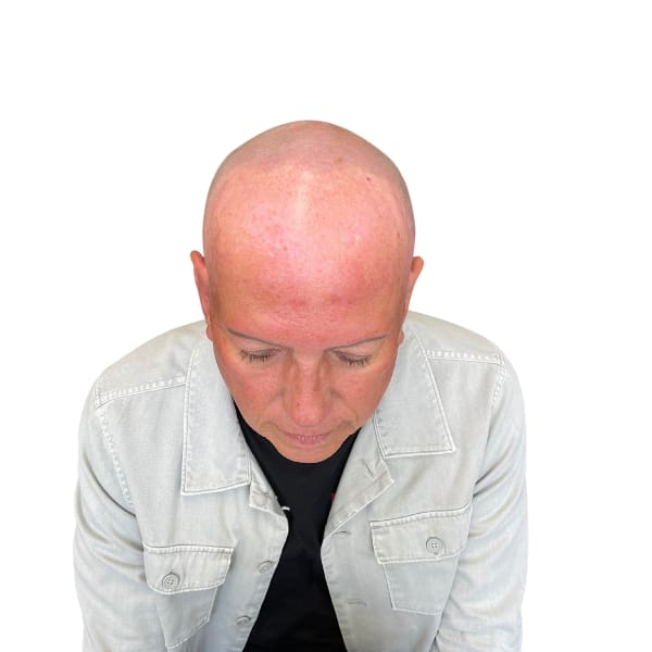 Alopecia Scalp Frankfurt